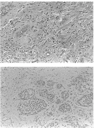 Fig 2. Diffusely  infiltrating,  single  cell  strands  of indian-file pattern  in  both  breast  tissues  (A).