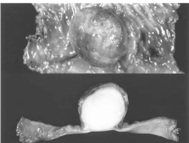 Fig. 1. Inflammatory fibroid polyp in the small bowel.