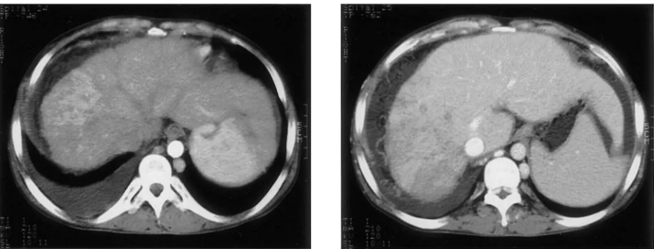 Fig. 2. IVC  venogram  findings.  There  is  noted  complete  obstruction  by  membranous  sturucture  at  IVC  adjacent  to rjght atrium (A) and balloon angioplasty was done (B).