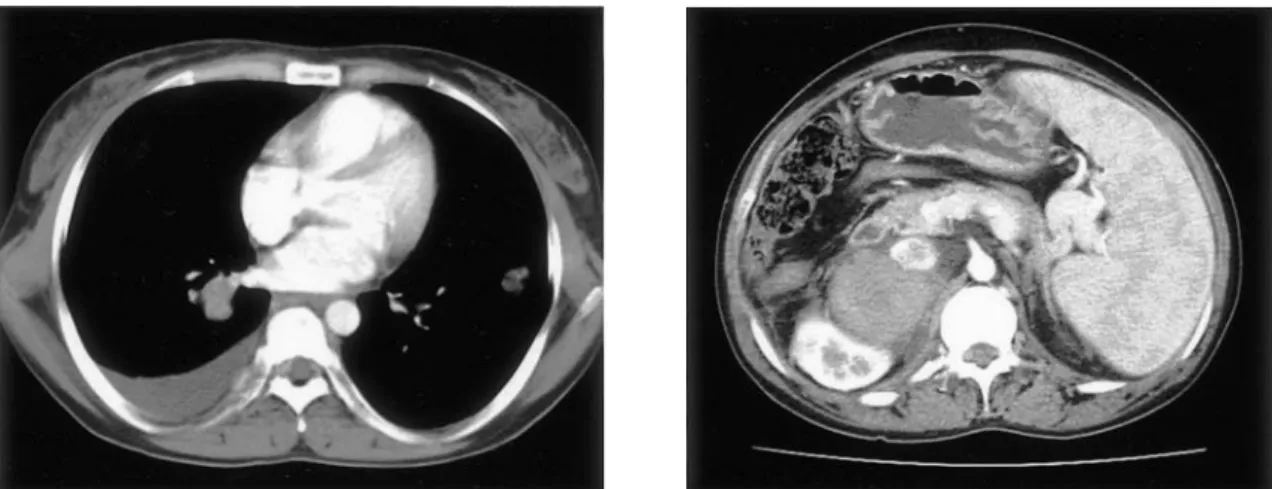 Fig. 3. CT  findings  after  1  year.  The  axial  images  of  the  chest  and  abdominal  CT  show  pulmonary  (A)  and  right adrenal metastasis (B).