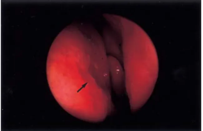 Fig. 3. Light  microscopic  finding  shows  an  intimate mixture  of  epithelial  and  stromal  elements (H&amp;E stain,  40).