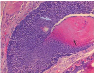 Fig. 3. Microscopic  finding  of  case  1  :  The  tumor composed  of  basaloid  cells  (white  arrow)  and ghost cells (black arrow) (H&amp;E stain,  200).