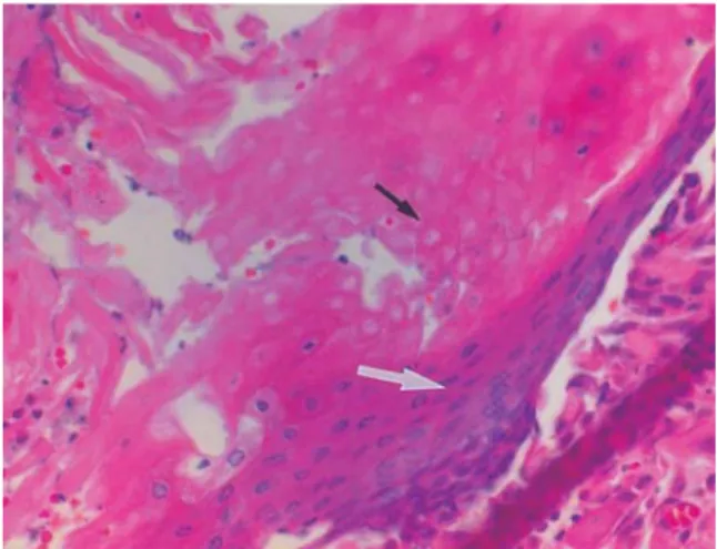 Fig. 5. Histologic  finding  of  the  case  2.  The  tumor  is composed  of  dark  basaloid  cells  (white  arrow) and light ghost cells (black arrow) (H&amp;E stain,