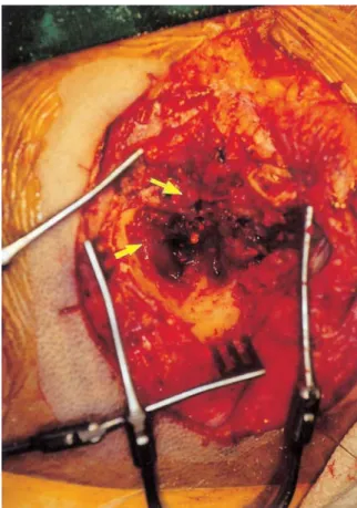 Fig. 1. Intraoperative  finding  in  case  1  shows  easily bleeding,  exophytic  tumor  mass,  occupying  the left  external  auditory  canal,  middle  ear  cavity and mastoid air cells (arrows).