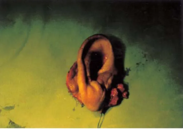 Fig. 4. Excised  tumor  mass  including  the  right  auricle in case 2.