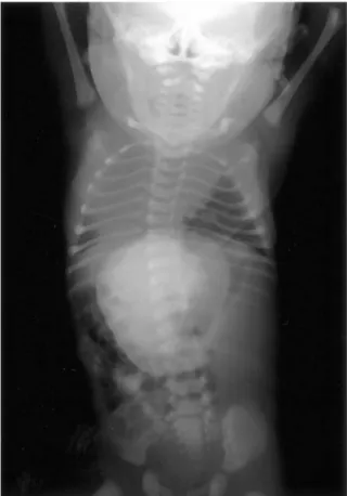 Fig. 2. Babygram  shows  hepato-omphalocele  and dextrocardia.