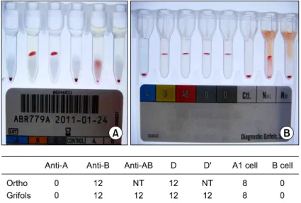 Fig.  3.  Electropherogram  of  ABO  genotyping.