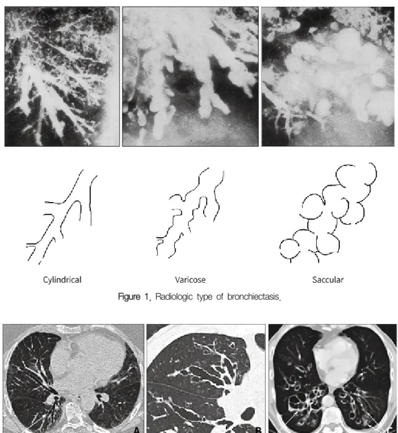 Figure  1.  Radiologic  type  of  bronchiectasis.