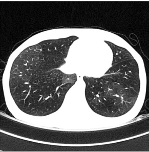 Figure  1.  Expiration  HRCT  of  patient  with  BOS.  Mosaic  attenuation  was  observed  due  to  air  trapping.