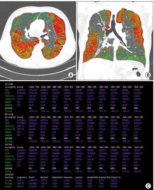 Figure  1.  Quantitative  analysis  using  inspiratory  CT  scan  in  62-year-old  male  patient  with  COPD  (FEV1/FVC  %  pred=51%,  FEV1  % pred=52%)