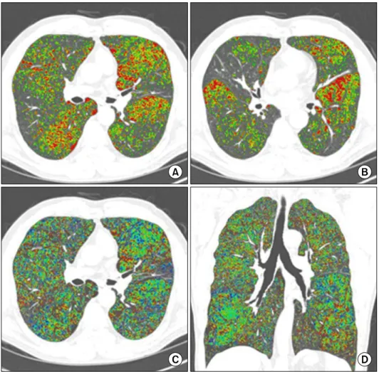 Figure 2. Air-trapping analysis using inspiratory and expiration CT scans in 62-year-old male patient with COPD (FEV1/FVC % pred=44%, FEV1 %  pred=36%)