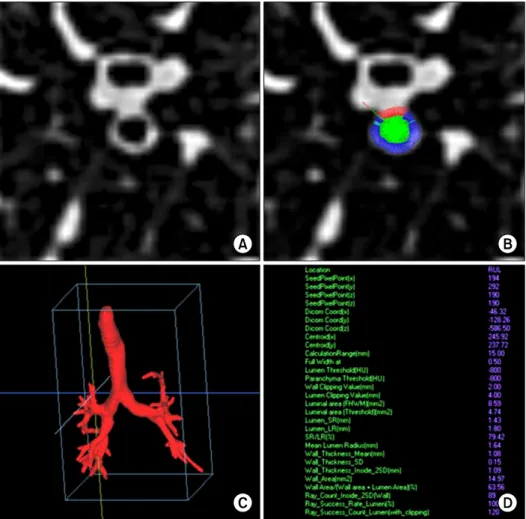 Figure  3.  Airway  measurement  using  inspiratory  CT  scan  in  76-year-old  male  patient  with  COPD  (FEV1/FVC  %  pred=55%,  FEV1  %  pred=69%)