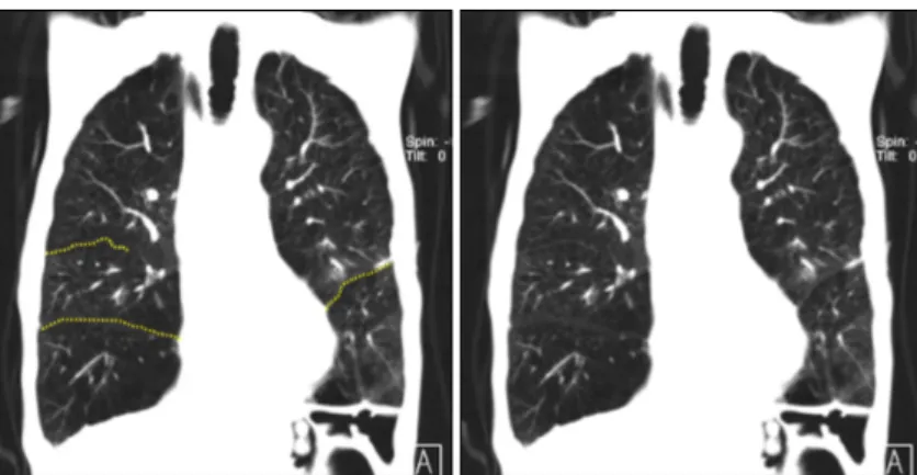 Figure  5.  The  medial  portion  of  minor  fissure  is  incomplete.  In  this  case,  the  probability  of  clinical  response  was  low,  if  the  target  lobe  is  right  uppper  lobe  or  right  middle  lobe,  because  of  collateral  ventilation  tho