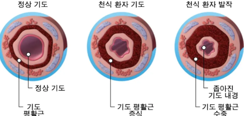 Figure  3.  치료군이  대조군에  비해  증상  및  급성  악화의  빈도를  유의하게  줄였다(reprinted  with  permission  of  the  American  Thoracic  Society) 12 