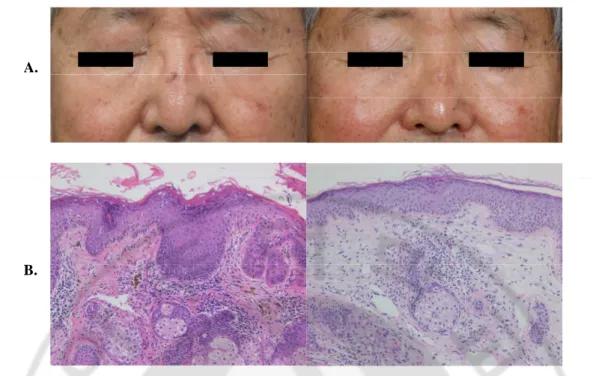 Fig. 1.  Clearance of AK after ALA-PDT . Patient 9 with actinic keratosis on the nose showed  complete  clinical  clearance  of  lesion  (A)