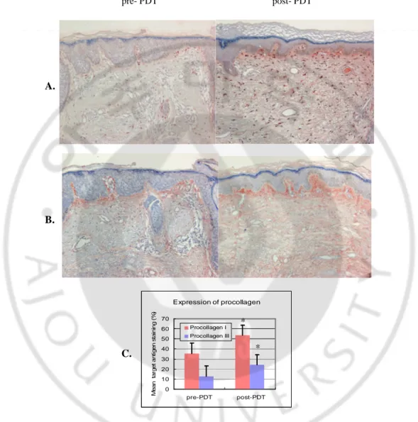 Fig.  4.  Increased  expression  of  type  I  and III  procollagen  after  ALA-PDT.  Type  I  (A)  and 