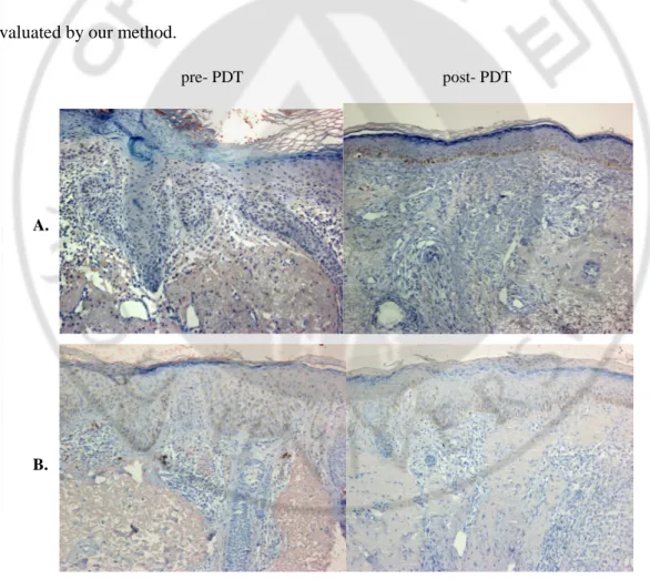 Fig.  8.  Decreased  fibrillin-1  and  tropoelastin  after  ALA-PDT.  The  fibrillin-1  (A)  and 
