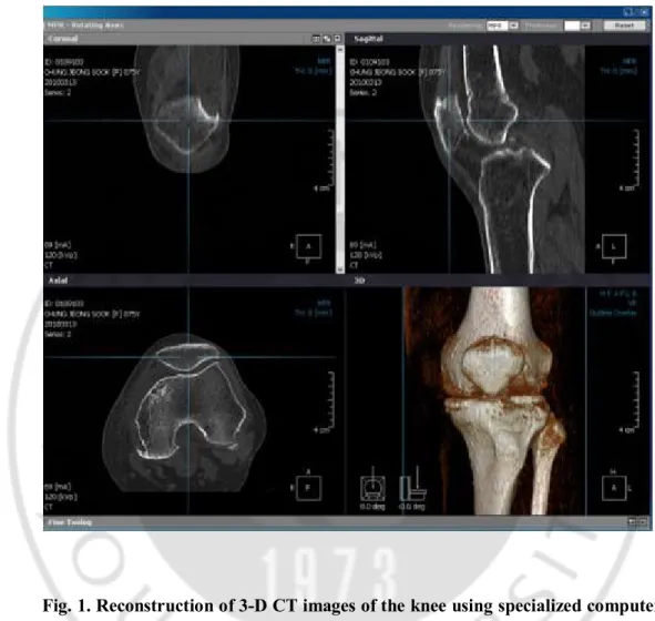Fig. 1. Reconstruction of 3-D CT images of the knee using specialized computer  software