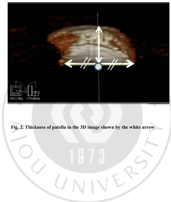 Fig. 2. Thickness of patella in the 3D image shown by the white arrow 