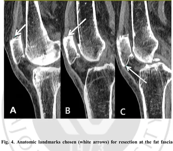 Fig.  4.  Anatomic  landmarks  chosen  (white  arrows)  for  resection  at  the  fat  fascia- fascia-tendon junctions for the fascia-tendon method of resection