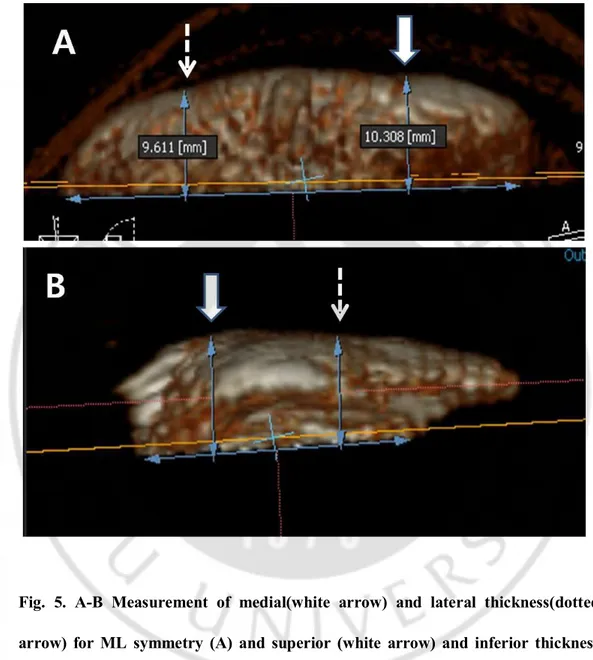 Fig.  5.  A-B  Measurement  of  medial(white  arrow)  and  lateral  thickness(dotted  arrow)  for  ML  symmetry  (A)  and  superior  (white  arrow)  and  inferior  thickness  (dotted arrow) for SI symmetry(B)