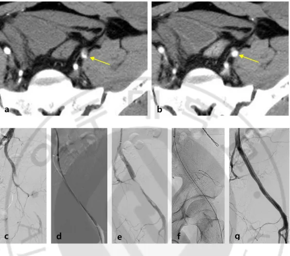 Fig.  1.  A  40-year-old  male  patient  was  injured  following  a  motorcycle  accident  resulting  in  dissection  that  extended  from  the  left  external  iliac  to  the  common  femoral  artery
