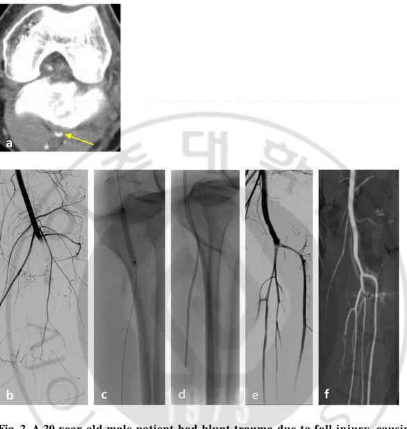 Fig. 2. A 20-year-old male patient  had blunt trauma due to fall injury, causing  left  popliteal  artery  dissection