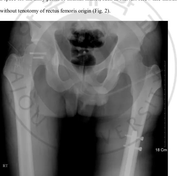 Fig.  2.  Open  reduction  and  internal  fixation  through  safe  triangle  by  Hervert  screws
