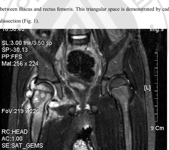 Fig.  3.  Acute  osteomyelitis  with  septic  hip  was  irrigated  and  was  done  bone  drilling through safe triangle