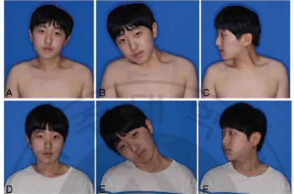FIGURE 3.Preoperative (upper row) and 3-month follow-up (lower row)photographs of a 12- 12-year-old boy with left-side torticollis