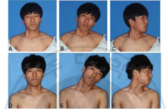 FIGURE 4. Preoperative (upper row) and 20-month follow-up (lower row)photographs of a 19- 19-year-old male patient with neglected right-sidetorticollis
