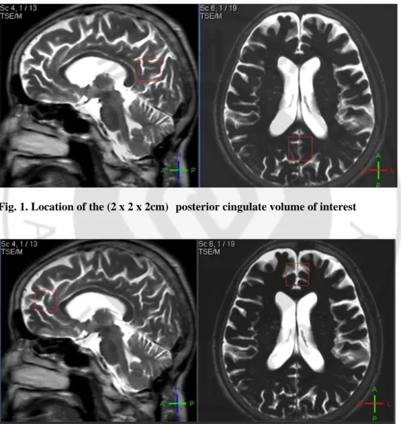 Fig. 1. Location of the (2 x 2 x 2cm)     posterior cingulate volume of interest 