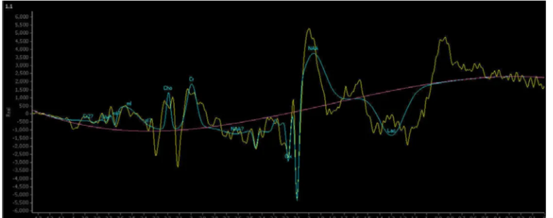 Fig. 3. Example of proton spectra obtained from the single-voxel MR spectroscopy 