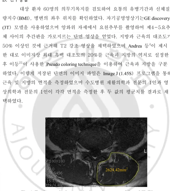 Fig. 1. Total area of left paraspinal muscle measured from MR T2    imagetransversing 4- 5 lumbar intervertebral disc 
