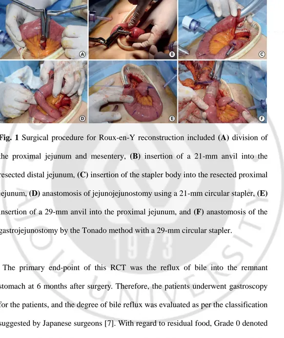 Fig.  1  Surgical  procedure  for  Roux-en-Y  reconstruction  included  (A)  division  of  the  proximal  jejunum  and  mesentery,  (B)  insertion  of  a  21-mm  anvil  into  the  resected distal jejunum, (C) insertion of the stapler body into the resected