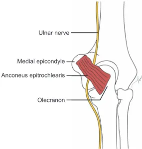 Fig. 1. Anatomical relationship between anconeus epitrochlearis muscle  and ulnar nerve