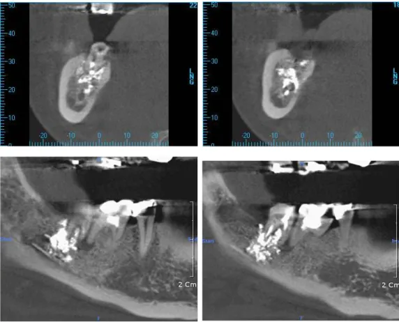 Fig. 2. The result of the Come-Beam Computered tomography(CBCT) at the first visit