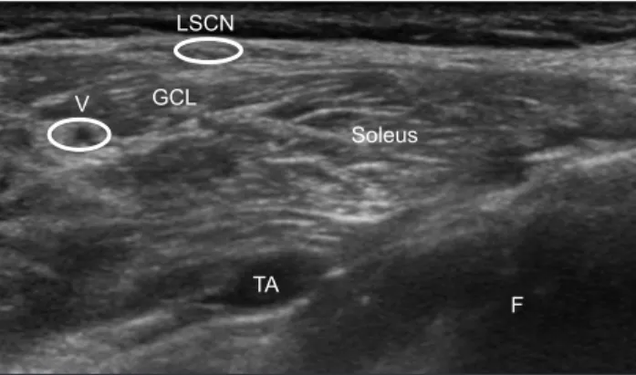 Fig. 4.	MRI	of	the	lower	leg:	the	right	peroneal	nerve	(arrow)	shows	 a	contusion	or	inflammatory	change