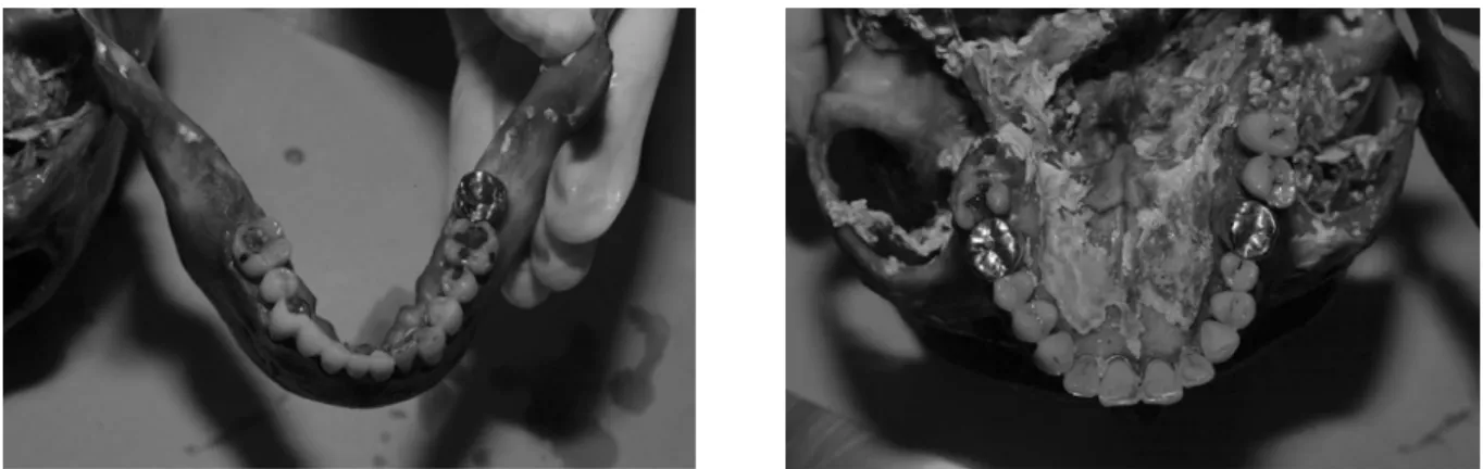 Fig.  3.  Visual  finding  of  Mandible  and  Maxilla 