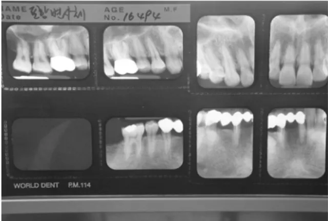 Fig.  5.  Model  for  age  estimation  by  attrition
