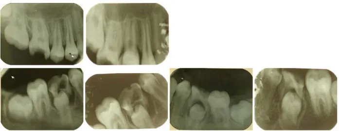 Fig.  16.  Antemortem  dental  x-ray