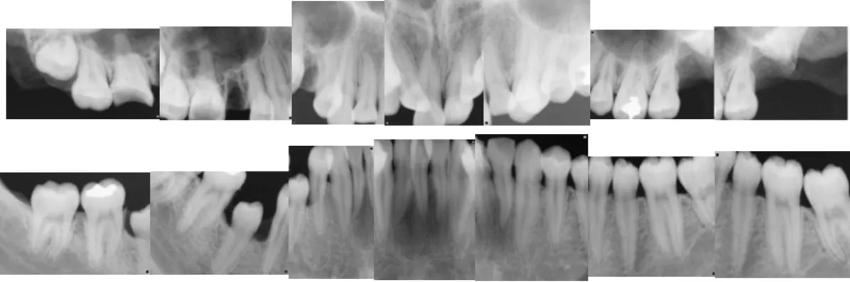 Fig.  17.  Postmortem  dental  x-ray 선 사진상의 영구치의 형태와 현재의 방사선 사진상 을 비교하는 수 밖에 없었으나 특징적인 매복치와 우 식증의 형태 그리고 각 영구치의 형태에서 동일인임 을  확인할  수  있었다(Fig