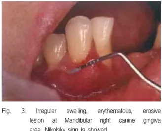 Fig.  5.  Light  microscopic  photograph.  Subbasilar  cleft  is  presented  between  basal  cell  layer  and  connective  tissue.