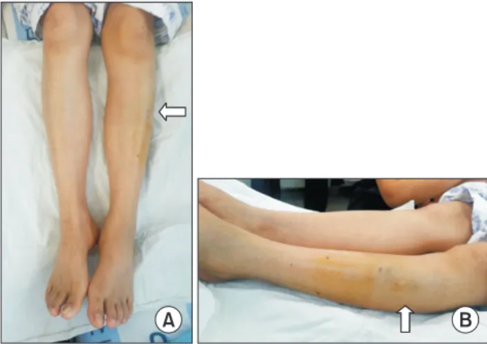 Fig. 1.	Swelling	and	ecchymosis	are	seen	on	left	lower	limb	(arrow).	