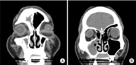 Fig. 4. Waters’  view one week after the sinus surgery. The radio- radio-pacity of the right maxillary sinus is reduced compared with those  of preoperative state but the haziness is still remaining