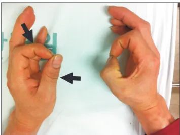 Fig. 1.	Typical	“OK”	sign	of	the	case	patient.	The	patient	was	unable	 to	flex	left	thumb	and	index	fingers	at	the	interphalangeal	and	the	 distal	interphalangeal	joint,	respectively	(arrows).