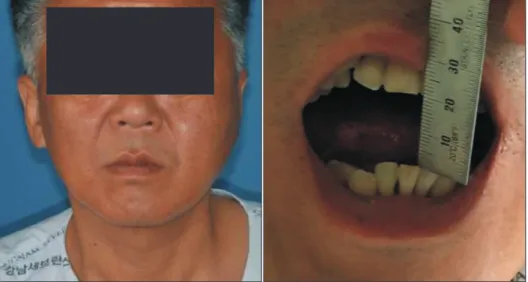 Fig. 1. Swelling of the left preauricular  area with restricted jaw movement.