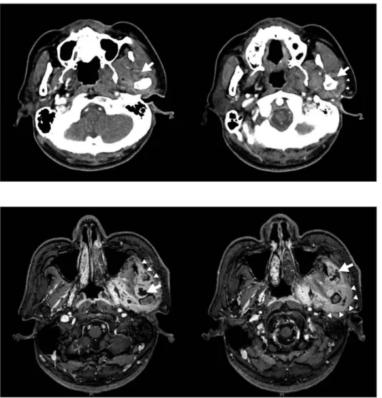 Fig. 3. Computed tomography shows  fluid  collection  (arrow)  and  diffuse  swelling of adjacent soft tissue  (arrow-head)