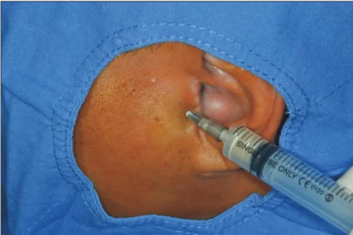 Fig. 5. Yellowish fluid aspirated from the joint space.