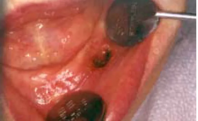 Fig.  7.  The  exophtic  lesion  of  the  lower  buccal  denture  margin(on  denture).